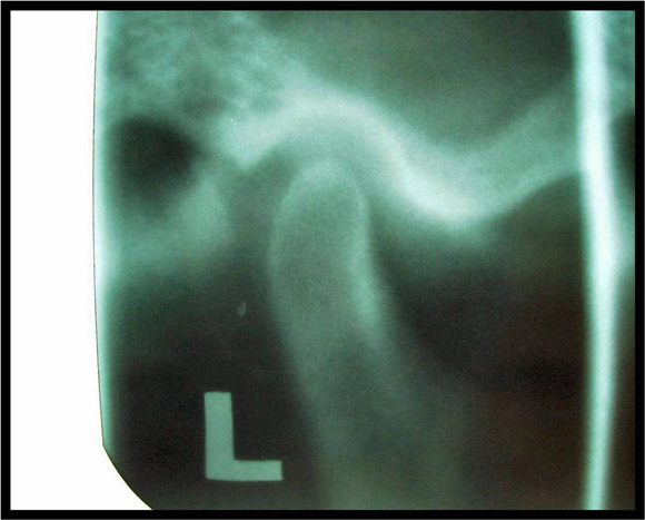 X-ray of normal temporomandibular joint.